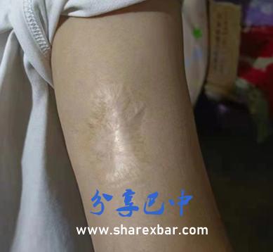 李有强左臂上割苦留痕(2022年8月19日摄)